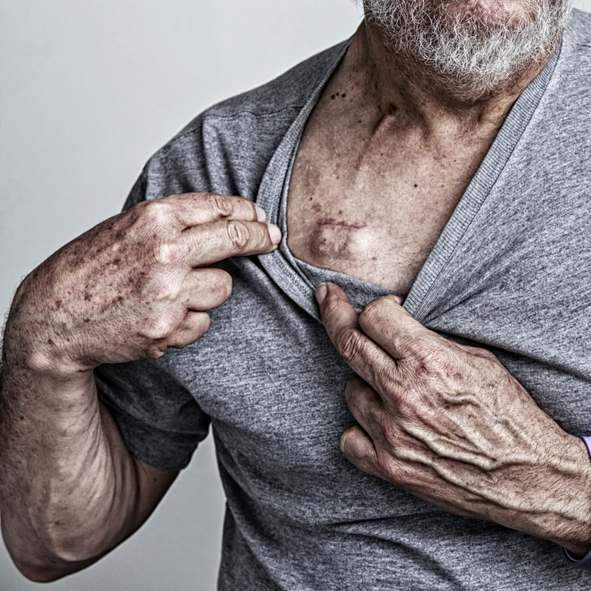 An authentic, real person senior adult man cancer patient recovering a week after his final chemotherapy treatment. He is pulling his t-shirt down to show the temporary intravenous IV port implanted in his chest. The rectangular lump is where a needle attached to the external infusion tube is inserted and then clamped in place. The subcutaneous catheter tube visible running up to the right from the port toward the neck leads up and then back down into one of the big veins above the heart. He has just finished three months of bi-weekly chemotherapy infusions which were required followed an emergency hospital stay with major surgery to remove a malignant intestinal cancer tumor.