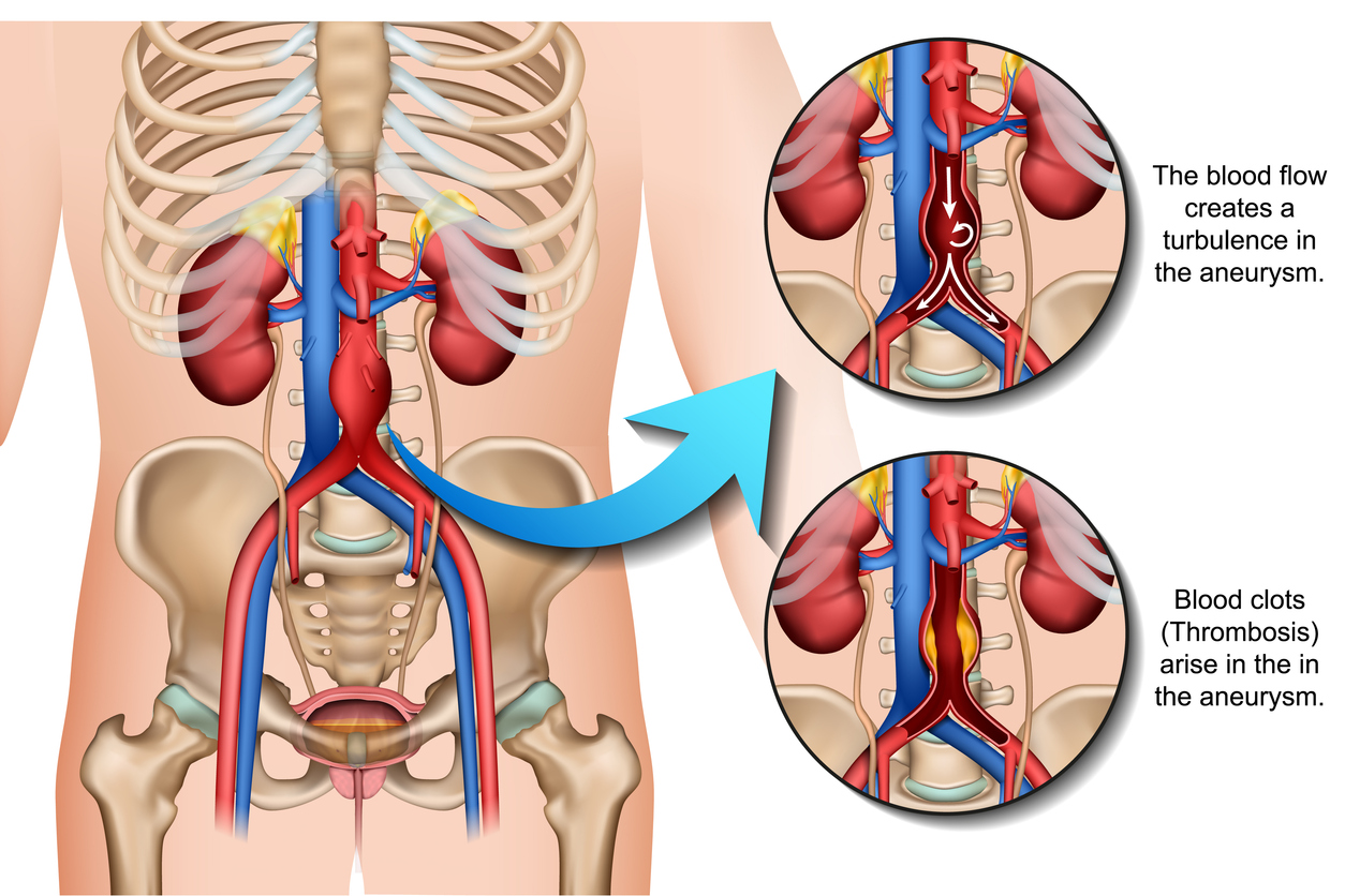Abdominal aneurysm 3d medical vector illustration isolated on white background eps 10 with description